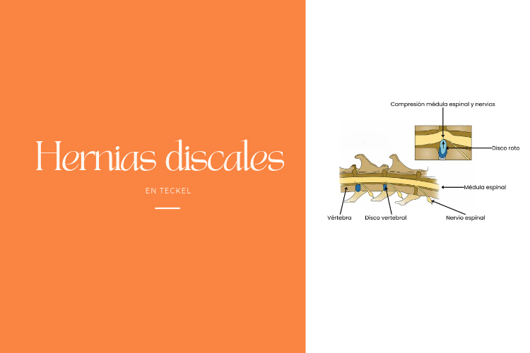 Hernias discales en Teckel
